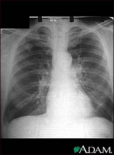 Adenocarcinoma - chest X-ray