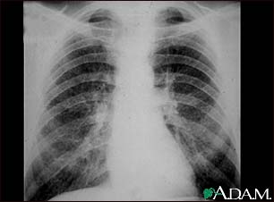 Coal workers pneumoconiosis - stage II Coal workers pneumoconiosis - stage II