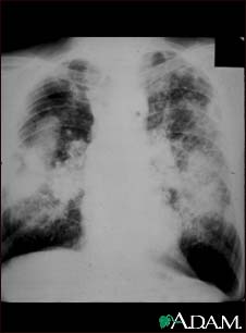 Coal workers pneumoconiosis, complicated #2 Coal workers pneumoconiosis, complicated #2