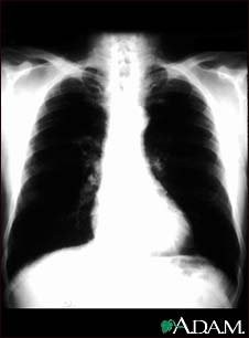 Bronchial cancer - chest X-ray Bronchial cancer - chest X-ray