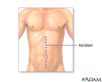 Incision