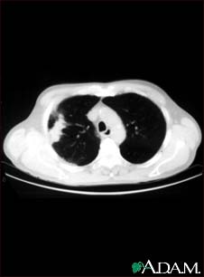 Lung with squamous cell cancer - CT scan Lung with squamous cell cancer - CT scan