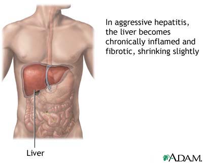 Aggressive hepatitis Aggressive hepatitis