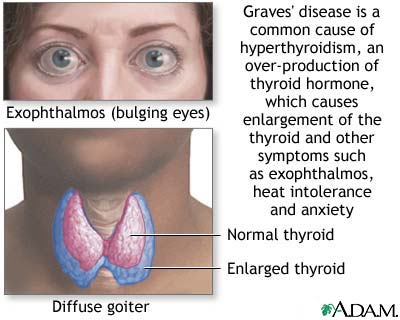 Graves' disease Graves' disease