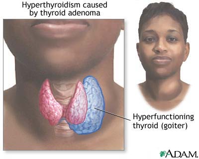 Hyperthyroidism Hyperthyroidism