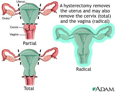 Hysterectomy Hysterectomy
