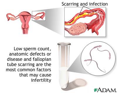 Primary infertility Primary infertility