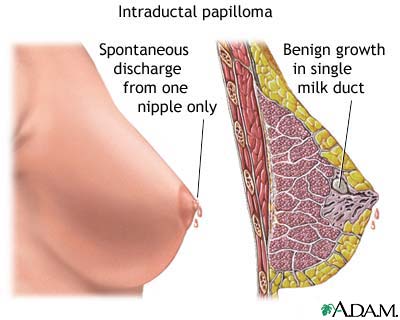 Intraductal papilloma Intraductal papilloma