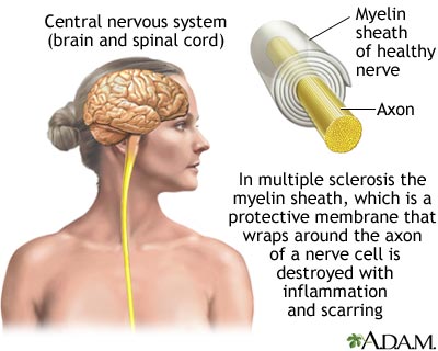 Multiple sclerosis Multiple sclerosis