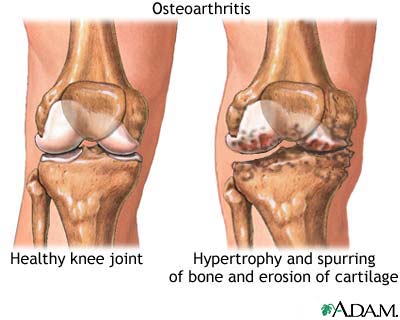 Osteoarthritis Osteoarthritis