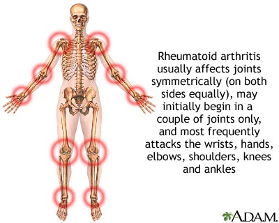 Rheumatoid arthritis Rheumatoid arthritis