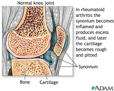 Rheumatoid arthritis Rheumatoid arthritis