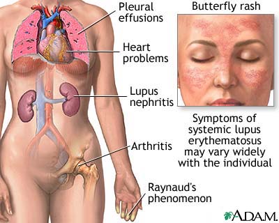 Systemic lupus erythematosus Systemic lupus erythematosus