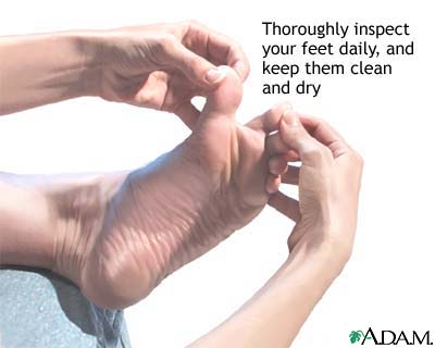 Diabetic foot care Diabetic foot care