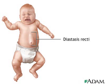 Diastasis recti