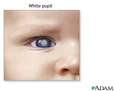 White spots in the pupil White spots in the pupil