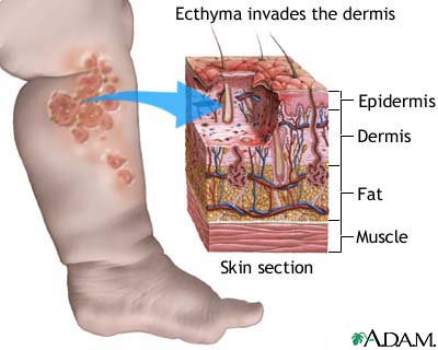 Ecthyma