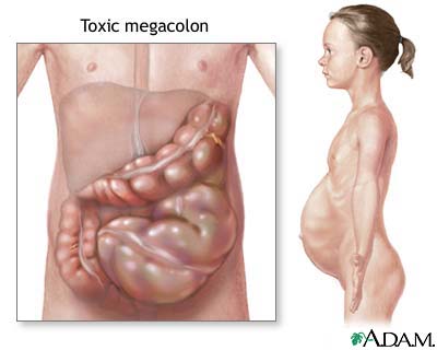 Toxic megacolon Toxic megacolon