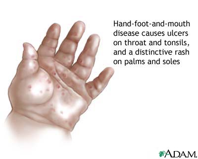 Hand-foot-and-mouth disease Hand-foot-and-mouth disease
