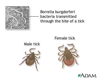 Tertiary Lyme disease Tertiary Lyme disease