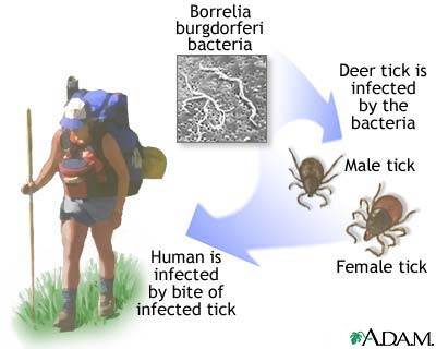 Lyme disease Lyme disease