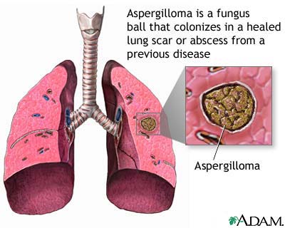 Aspergilloma Aspergilloma