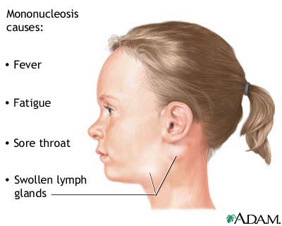 Infectious mononucleosis Infectious mononucleosis