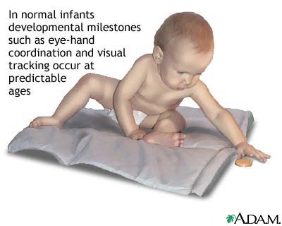 Motormental retardation Motormental retardation