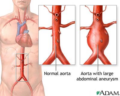 Aortic aneurysm Aortic aneurysm
