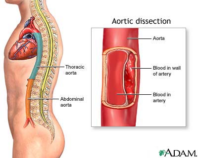 Aortic dissection Aortic dissection