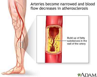 Arteriosclerosis of the extremities Arteriosclerosis of the extremities