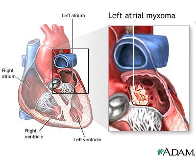 Left atrial myxoma Left atrial myxoma