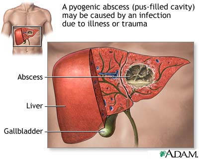Pyogenic abscess Pyogenic abscess