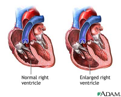 Tricuspid Regurgitation Tricuspid Regurgitation