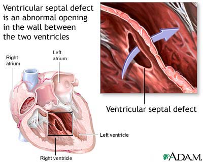 Ventricular septal defect Ventricular septal defect