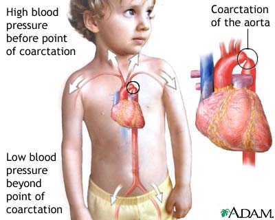 Coarctation of the aorta Coarctation of the aorta