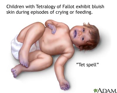 Cyanotic 'Tet spell' Cyanotic 'Tet spell'