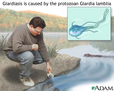 Giardiasis Giardiasis