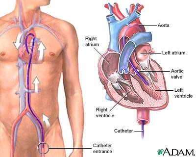 Left heart catheterization Left heart catheterization