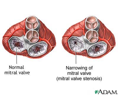 Mitral stenosis Mitral stenosis