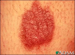 Burn, thermal - close-up Burn, thermal - close-up