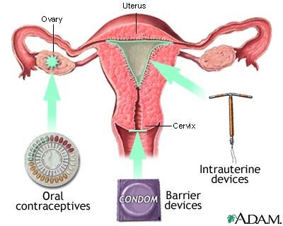 Birth control methods Birth control methods