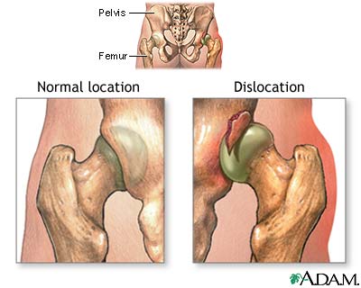 Dislocation of the hip