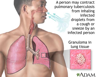 Tuberculosis of the lungs Tuberculosis of the lungs