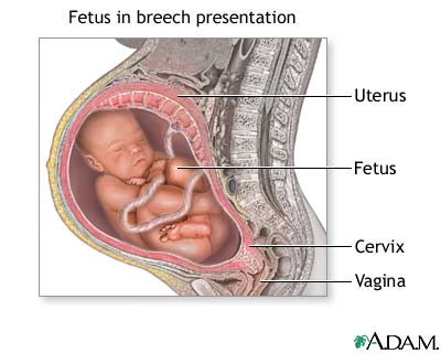 Breech presentation