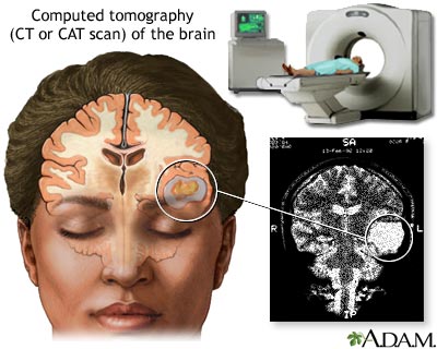 CT scan of the brain CT scan of the brain