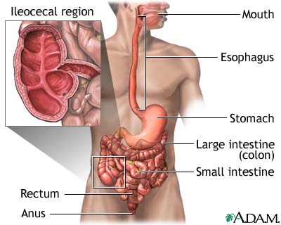Crohn's disease - affected areas Crohn's disease - affected areas