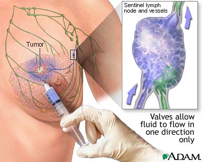 Sentinel node biopsy Sentinel node biopsy