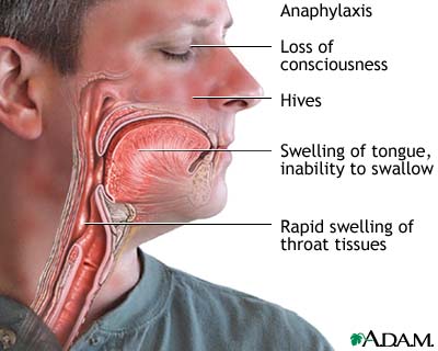 Anaphylaxis Anaphylaxis