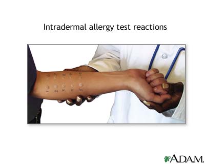 Intradermal allergy test reactions Intradermal allergy test reactions